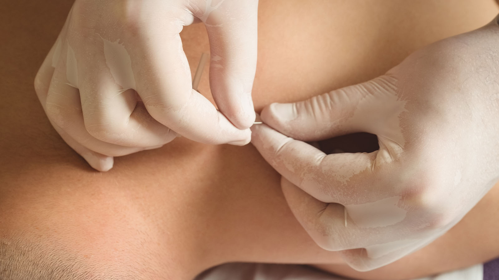 Dryneedling